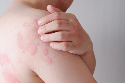 Svrbive vyrazky sa objavia v priebehu minut chlad moze vyvolat aj zivot ohrozujuceu reakciu