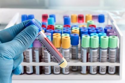 Castiejsie nou trpia potomkovia Keltov postihuje aj Slovakov Neliecena hemochromatoza moze viezt k cirhoze pecee